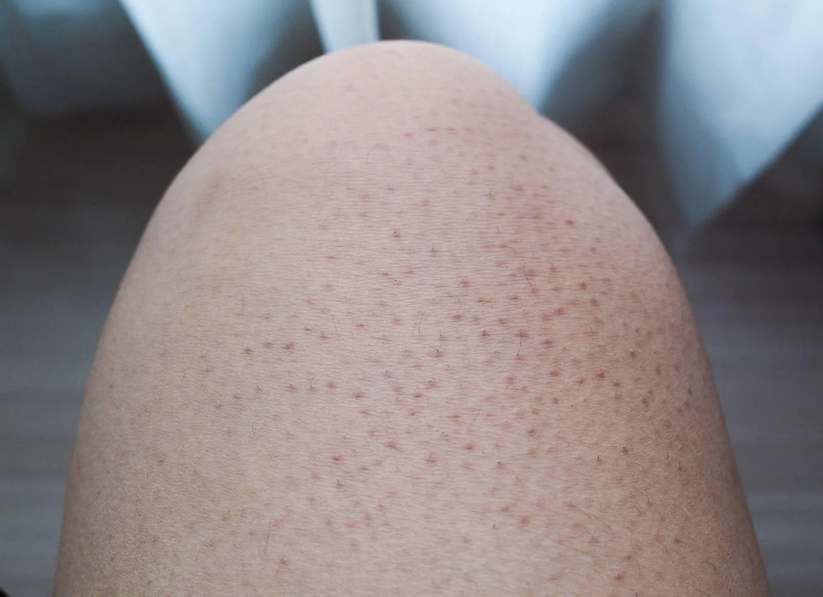 Keratosis Pilaris