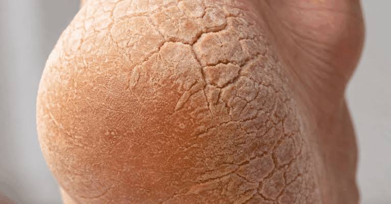Rough, Thickened Skin
