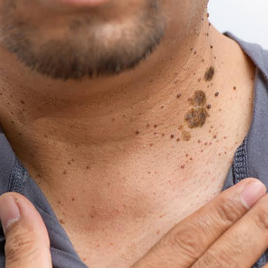 Seborrheic Keratoses / Barnacles / Rough, Raised Spots